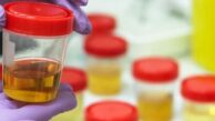 Hangi İdrar Rengi Hangi Hastalığın Habercisidir
