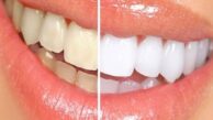DİŞ BEYAZLATIRKEN BU NOKTALARA DİKKAT !